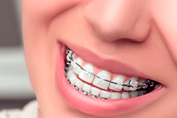 What Kind Of Braces Should Your Child Get?