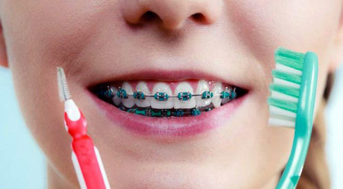 How to Take Care of your Child’s Dental Braces