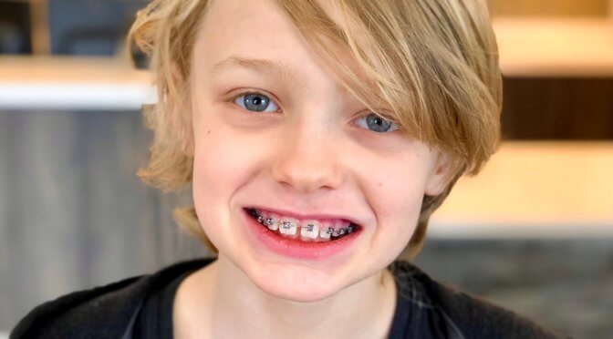 Is There a Right Age for Braces?